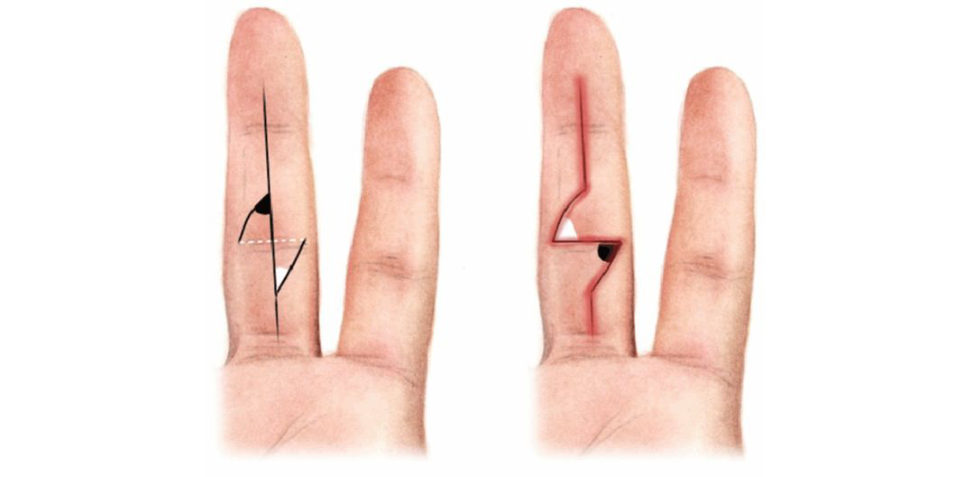 Figure 17.12b